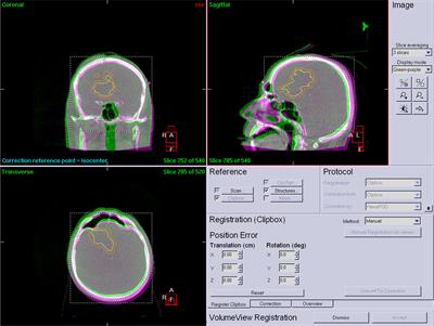 CBCT Verification of SRT for Patients With Brain Metastases